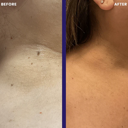 TagPal™ – Elimina Verrugas de Forma Segura y sin Dolor en Casa