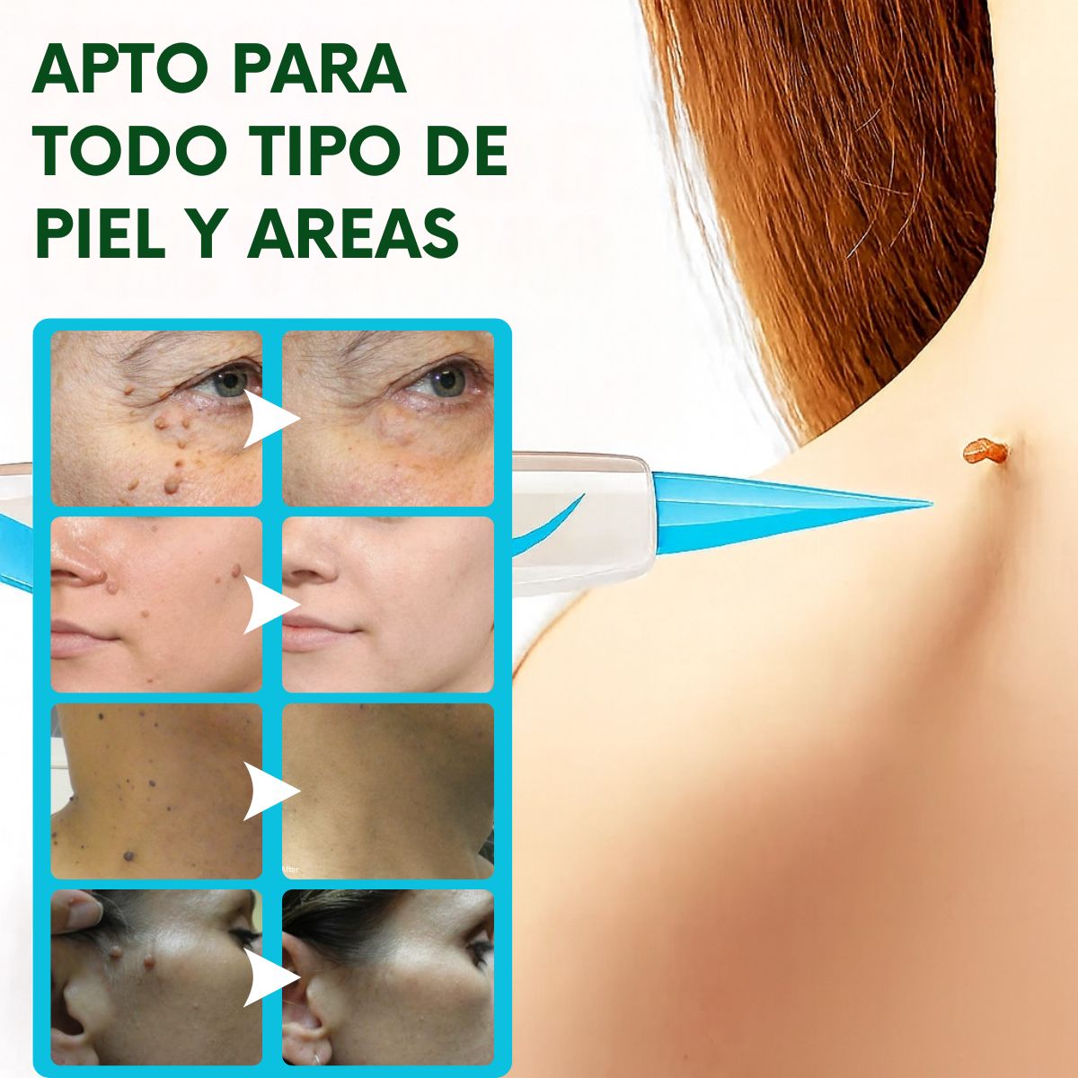 TagPal™ – Elimina Verrugas de Forma Segura y sin Dolor en Casa