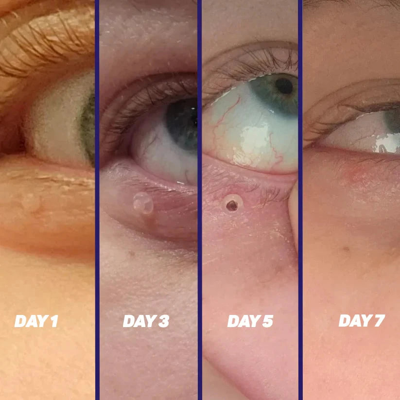 TagPal™ – Elimina Verrugas de Forma Segura y sin Dolor en Casa